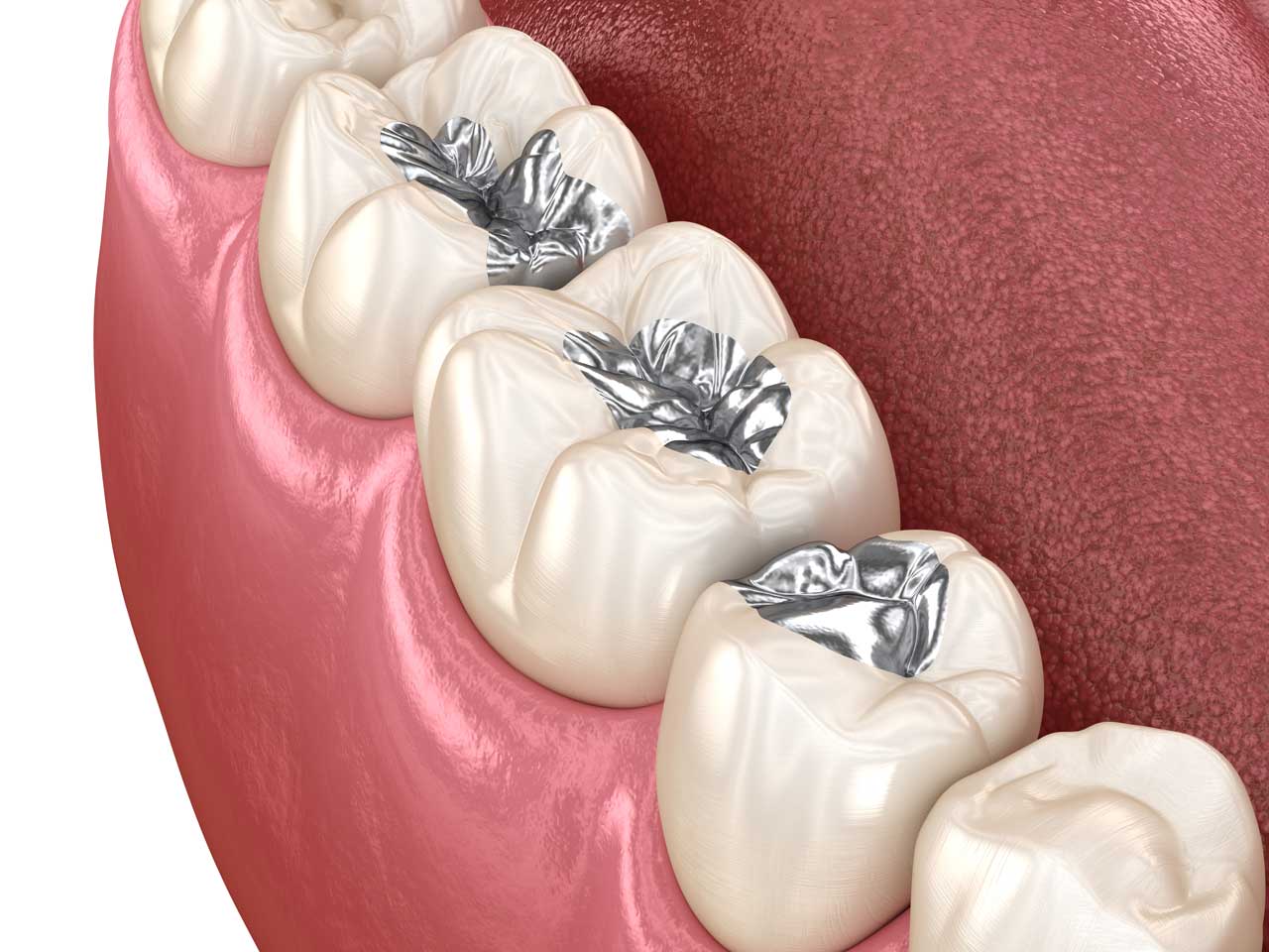 Tooth Filling